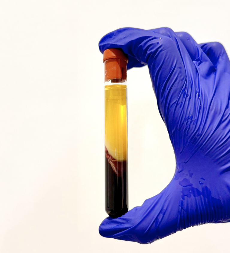 PRP treatment image for platelet-rich plasma skin consultation